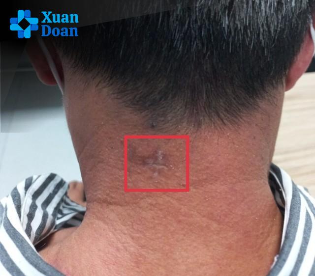 Tóm Tắt: Nhận Biết Sớm Thoát Vị Đĩa Đệm Cột Sống Cổ, Tránh Nhầm Lẫn Với Đột Quỵ, Bảo Vệ Sức Khỏe Toàn Diện