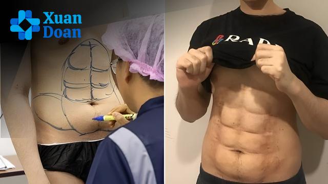 Đánh Giá Khách Quan: Ưu và Nhược Điểm Của Phẫu Thuật Tạo Cơ Bụng Giả